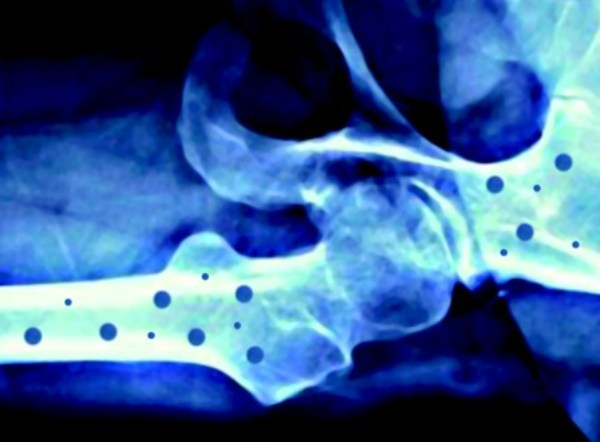 Salute, l’osteoporosi costa alla Ue 37 miliardi l’anno